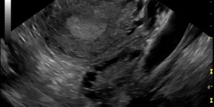 Briser le silence sur la santé des femmes : le cas du SOPK