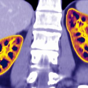 How an Algorithm Blocked Kidney Transplants to Black Patients