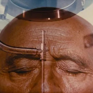 Neuralink attire 1000 volontaires tétraplégiques pour tester son implant cérébral, malgré un premier essai mitigé
