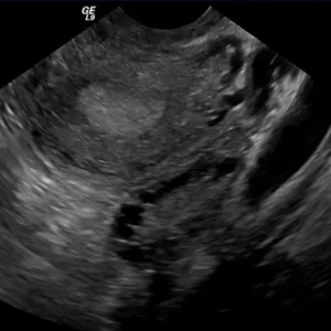 Briser le silence sur la santé des femmes : le cas du SOPK