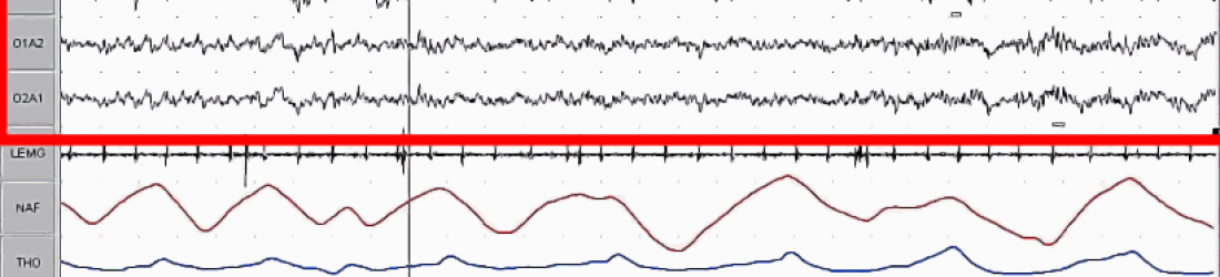 Sommeil paradoxal — Wikipédia