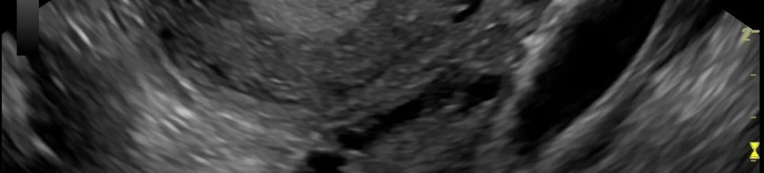 Briser le silence sur la santé des femmes : le cas du SOPK